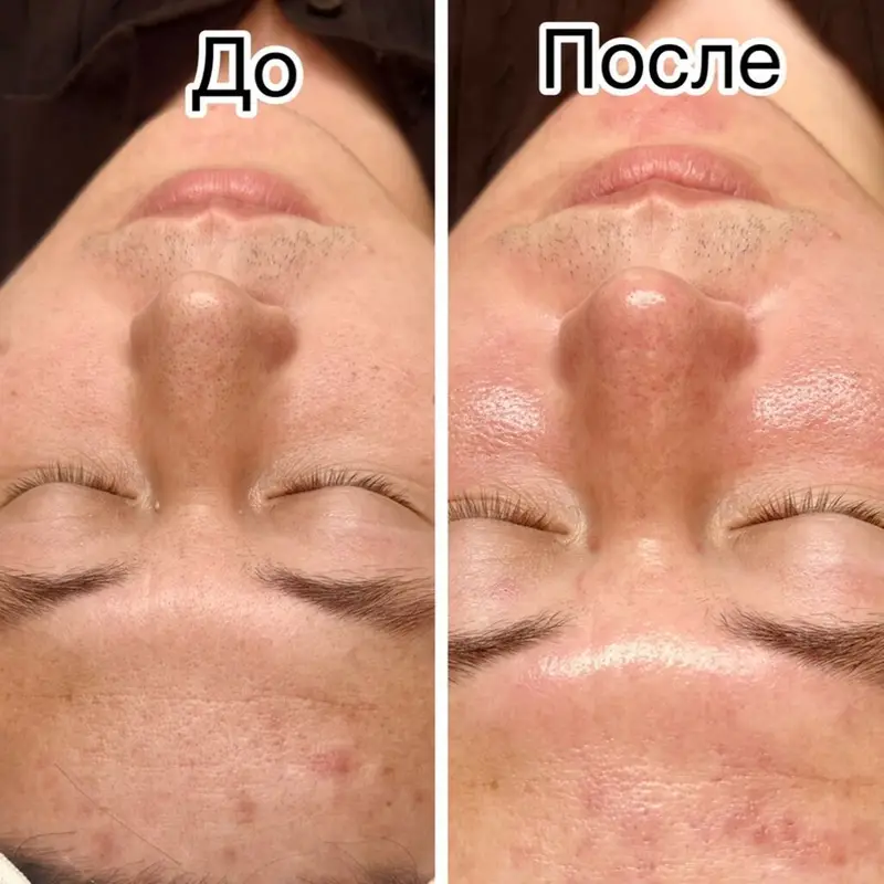 Чистка лица-2500 сом — фото 5