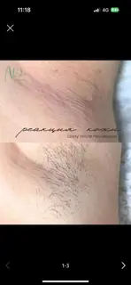 Женская/мужская депиляция: шугаринг и восковая эпиляция