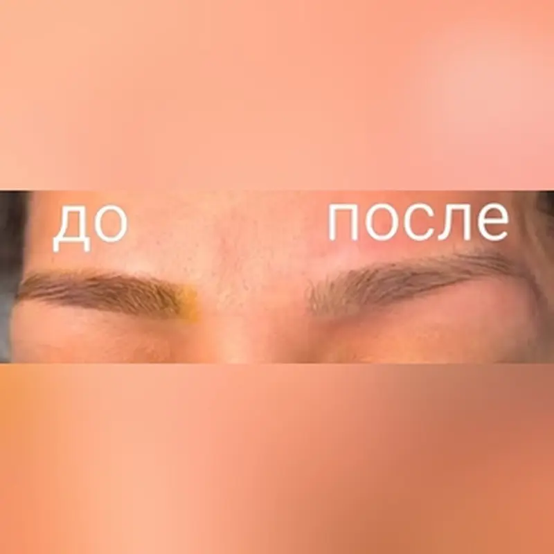 Лазерное удаление перманентного макияжа и татуажа — фото 3
