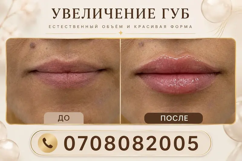 Контурная пластика губ гиалуроновым филлером. — фото 4