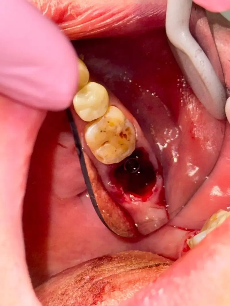 🦷 Успейте восстановить улыбку по специальной цене! Имплантация Dio — фото 2