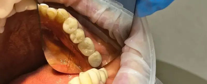 🦷 Успейте восстановить улыбку по специальной цене! Имплантация Dio — фото 3