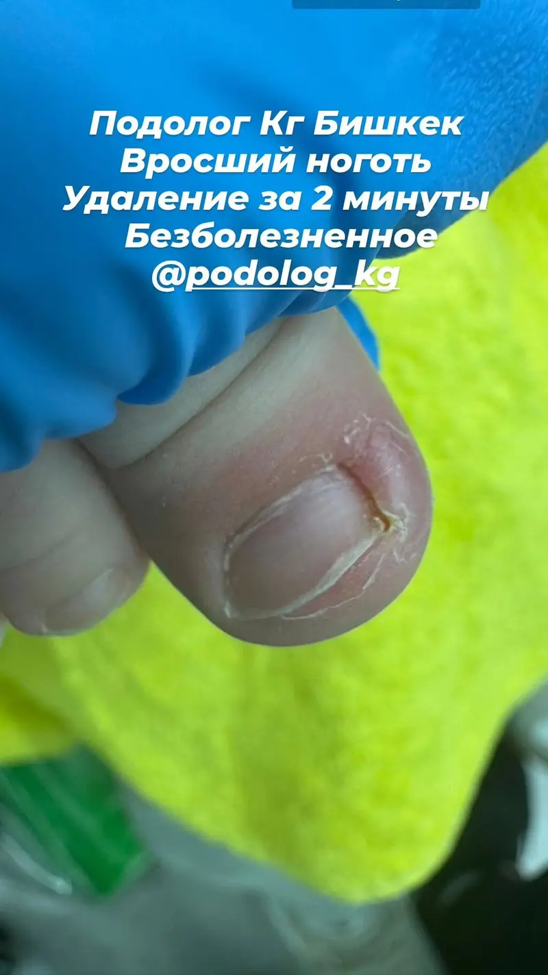 Детский подолог, Бишкек — лечение вросшего ногтя @podolog_kg — фото 2