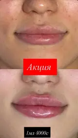 Контурная пластика губ (увеличение и коррекция)