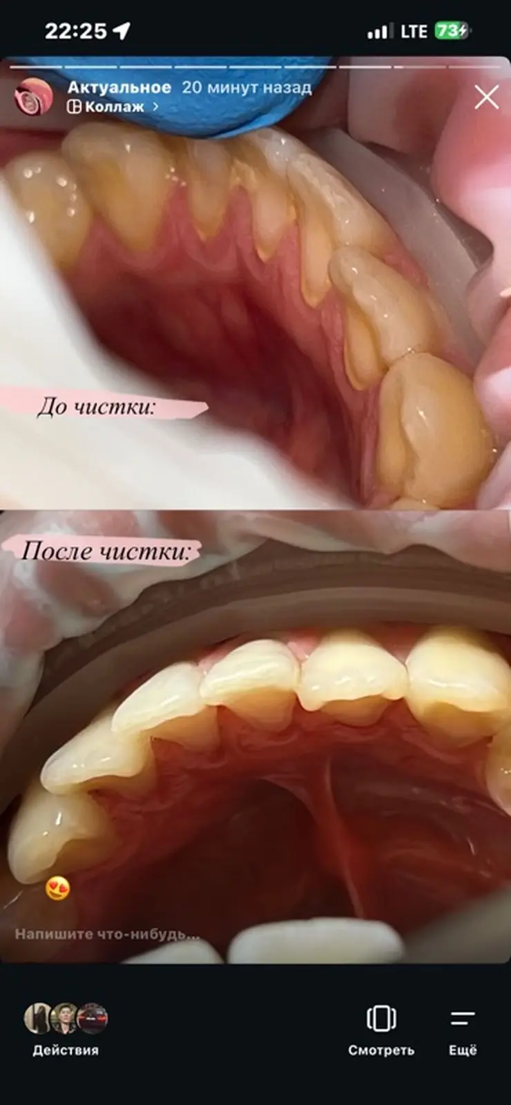 Профессиональная гигиена+отбеливание зубов=3800c — фото 2