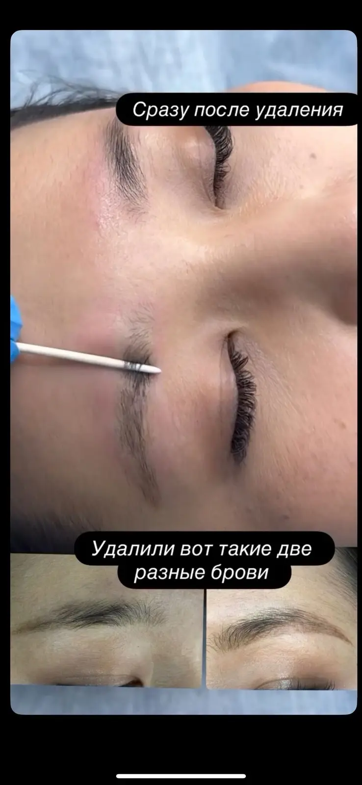 АКЦИЯ !АКЦИЯ! УДАЛЕНИЯ БРОВЕЙ Новый метод удаления Сейчас по акции — фото 3